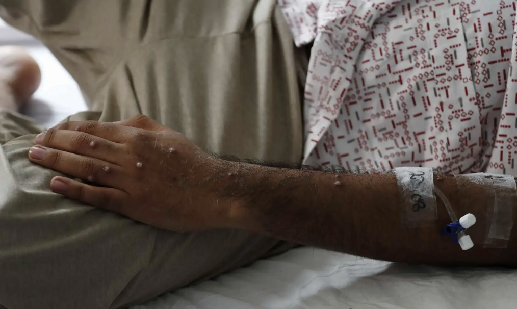 OMS DECLARA NUEVA EMERGENCIA MUNDIAL POR BROTE DE VIRUELA DEL MONO